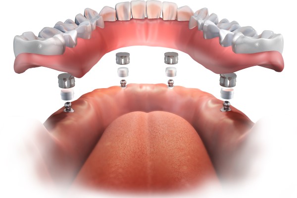 All On 4 Dental Implants Torrance, CA