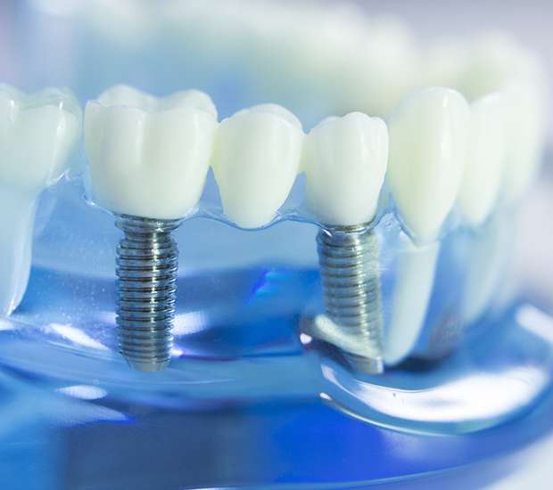 Torrance Dental Implants