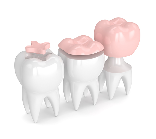 Torrance Dental Inlays and Onlays