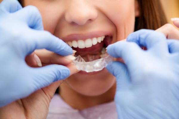 What Are Invisalign Clear Aligners?